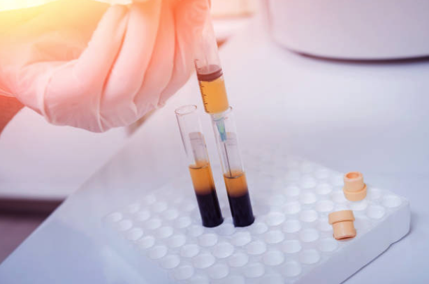 Hand in a glove holding a syringe above test tubes containing yellow and dark liquid, illustrating the preparation of Platelet-Rich Plasma (PRP) for pain management and healing treatments.