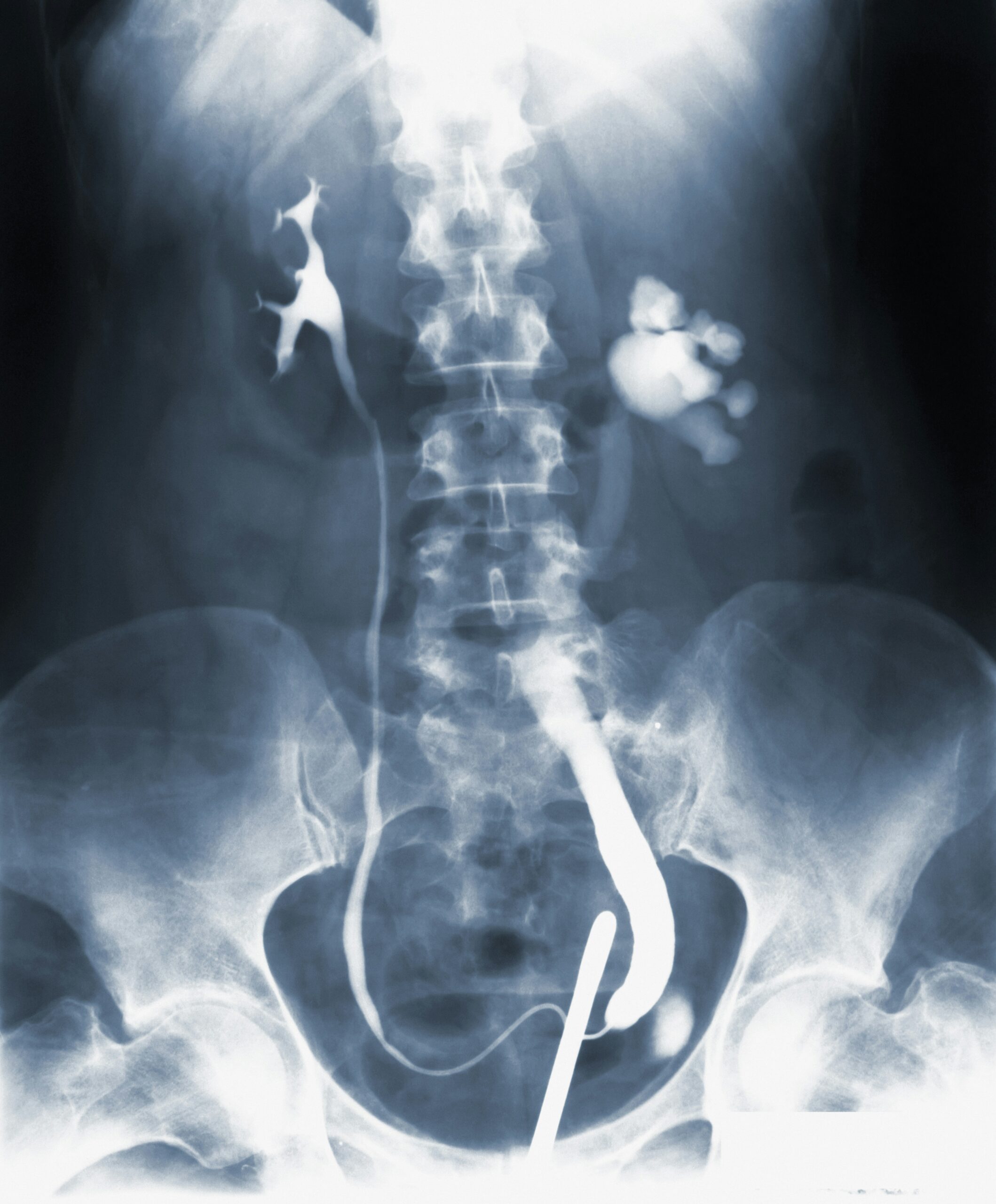 X-ray image of the spine highlighting potential issues related to Failed Back Surgery Syndrome (FBSS) treatment options.
